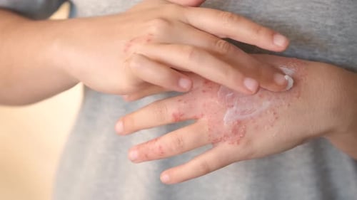 Woman applying ointment or moisturizing cream in the eczema, atopic dermatitis.