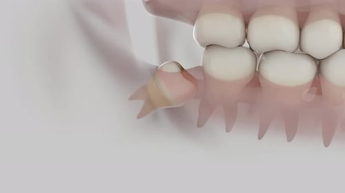 Wisdom Tooth Pain