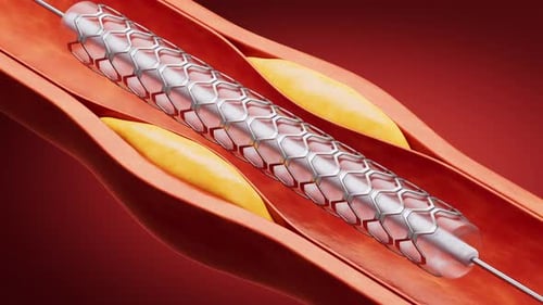 Medical Stent Insertion and Artery Plaque Removal Animation