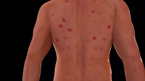 3D Animated Skin Lesions on Human Back Model