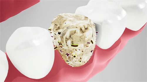 Tooth Decay and Bacterial Growth Medical Animation