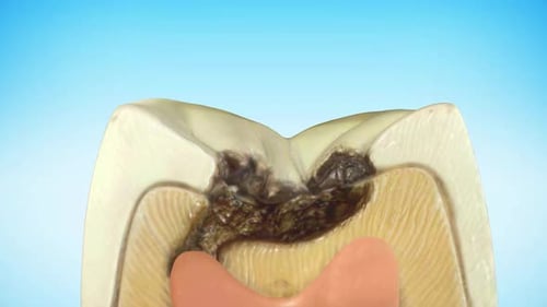 3D Medical Animation of Tooth Decay and Filling