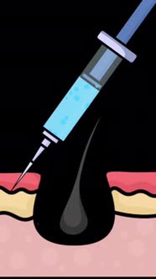 Hair Loss Growth Injection Process On Alpha Channel Vertical