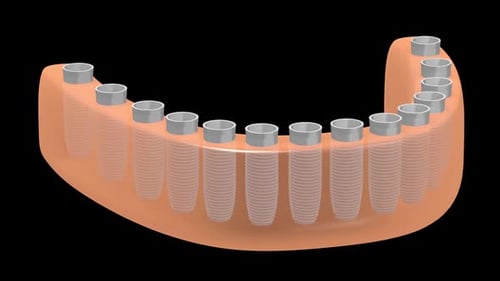 3D Dental Implant Installation Process in Jawbone Animation