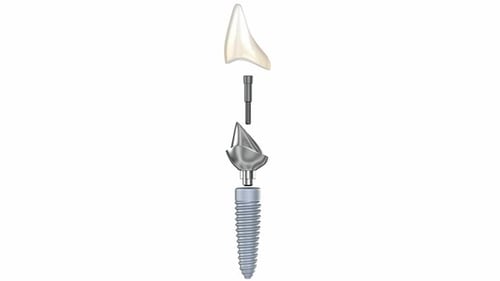 3D Dental Implant Assembly and Disassembly Animation