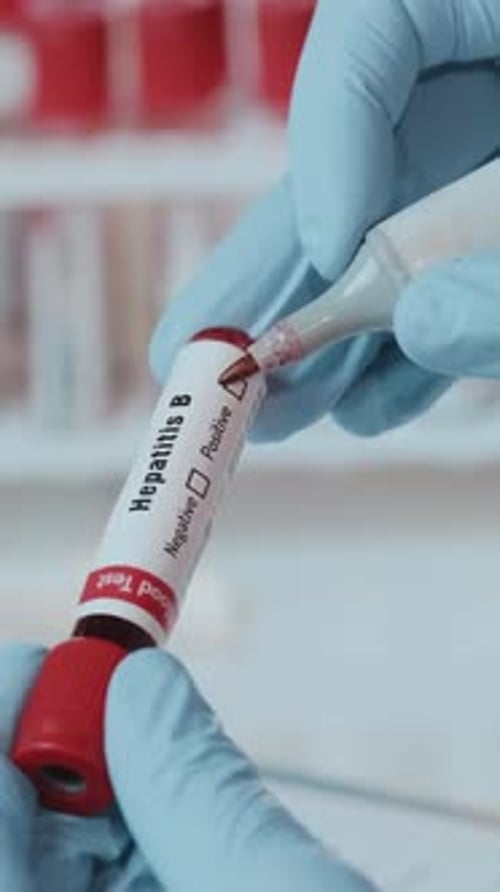Positive Hepatitis B Blood Test in Laboratory