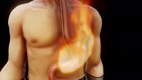 3D Animation of Heartburn and Acid Reflux in Human Body