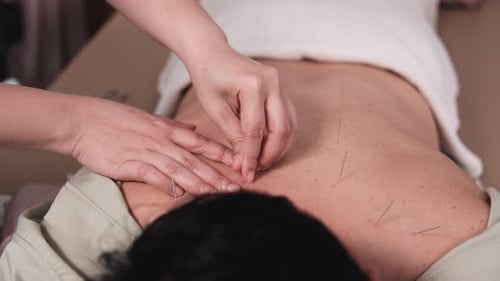 Plan rapproché d'une procédure d'acupuncture pour soulager les maux de dos.