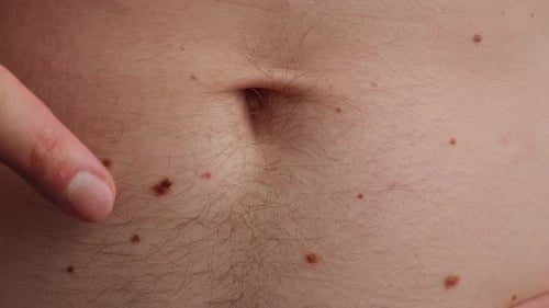 Unerkennbarer Mann, der seine Muttermale auf der Haut zeigt, Nahaufnahme der Sonnenexposition mit nackter Haut