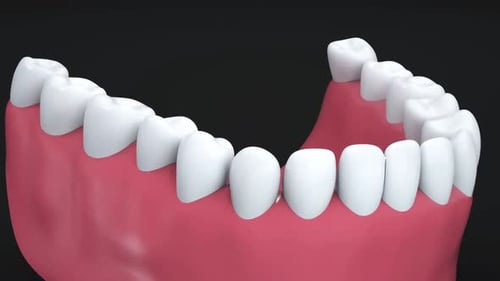 Oral Health: 3D Animation of Tooth Replacement and Restoration