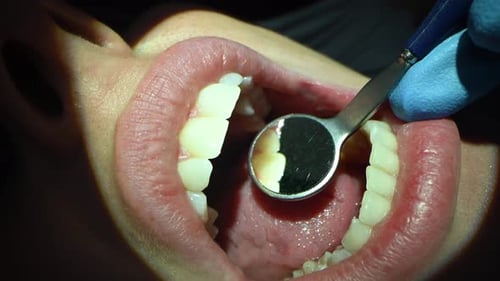 Dental Care Extreme Close Up Macro Video Dentist Treat Patient Teeth Orthodontist Works with