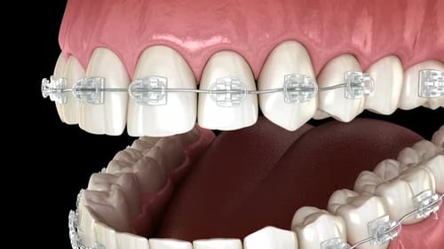 Instalación de aparatos dentales transparentes en los dientes.