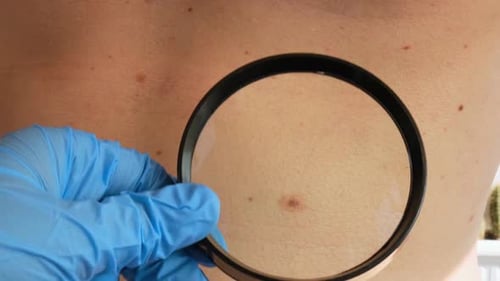 Examining Back Skin with Magnifying Glass