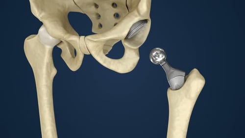 3D Animation of Total Hip Replacement Prosthesis Implantation