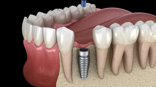 3D Animated Dental Implant Placement in Human Jaw