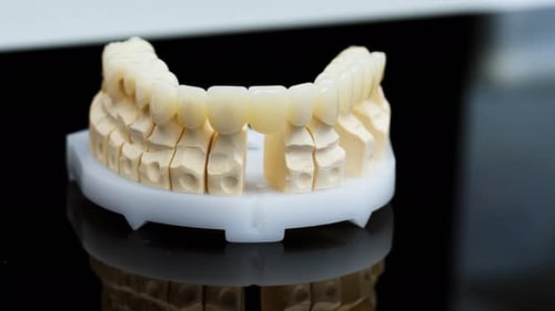 Dental Bridge Model for Tooth Replacement in Clinic
