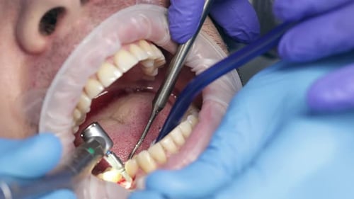Dentist Working on Patient's Teeth Close-Up