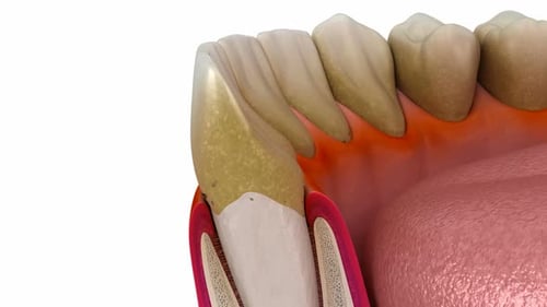 Periodontitis, gum recession process