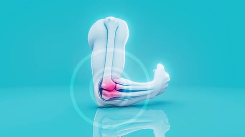 Conceptual 3D animation of a tennis elbow inflammation