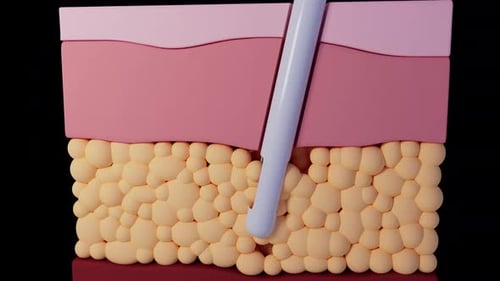Animated Medical Procedure: Needle Insertion into Skin Layers