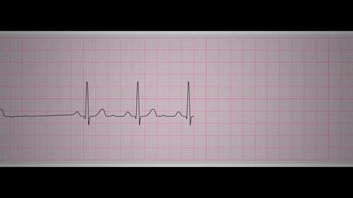 Heart rhythm displayed on medical monitor
