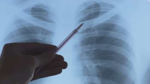 Chest X-Ray Examined with Hand and Pen