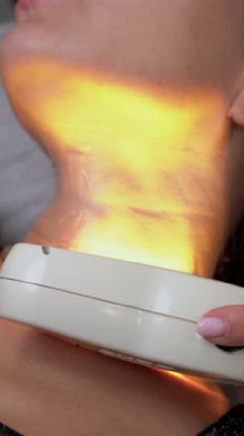 Vertical Video of Laser Skin Rejuvenation on Young Woman Neck in Medical Clinic