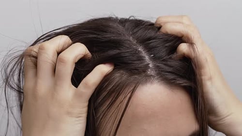 Woman Massaging Scalp with Dandruff