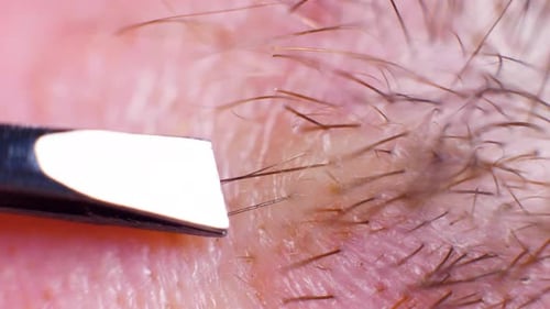 4K Super macro shot of hair removal with tweezers, on a caucasian person, at an extreme close up, in