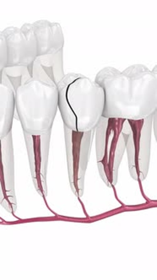 Medical Animation of Cracked Tooth and Root Inflammation