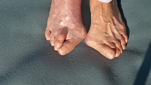 Feet Show Swelling on Elderly Person