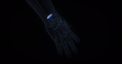Pronator quadratus muscle in human body. X Ray. Loop