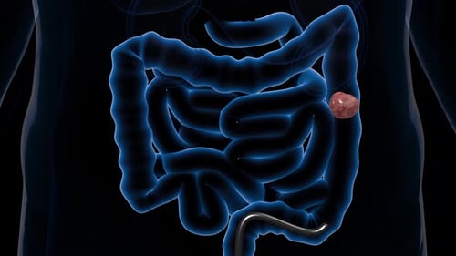 obstruction in the intestines