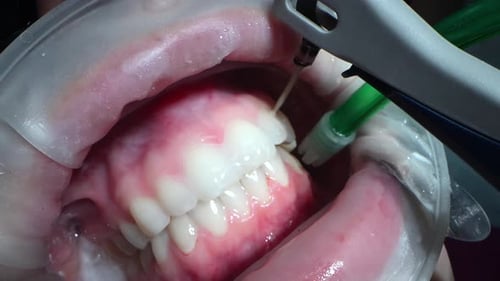 Vidéo macro Dental Extreme Close Up Processus de nettoyage dentaire chez le patient : nettoyez les dents avec de l'eau