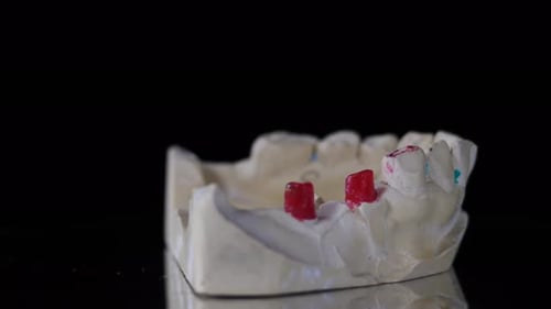 Dental Mold with Crown Being Placed Close Up