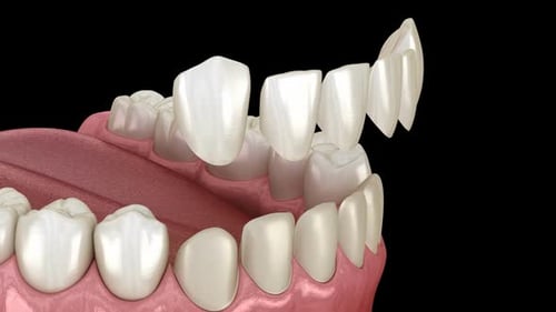 Veneer installation procedure over central incisor and lateral incisor