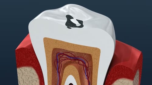 Root canal infection process. 3D Animation