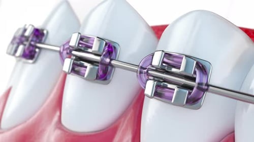 Close Up of Human Teeth Model with a Dental Braces Orthodontic Treatment and Dental Care