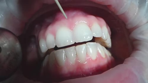 Dental Extreme Close Up Makro Video Reinigungsprozess im Mund des Patienten Zähne mit Wasserstrahl reinigen