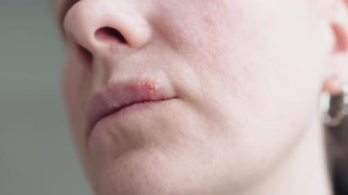 Woman with Sore on Lips Herpes Simplex Virus Vesicles on Lip Skin Macro
