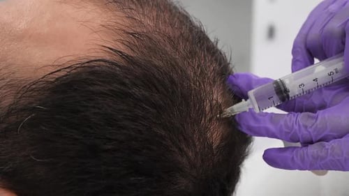 Scalp Injection Treatment Performed by Doctor