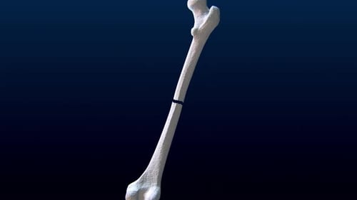 3D Medical Animation of Bone Fracture Repair Process