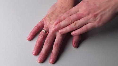 Woman with red dry and itchy skin apply hand cream on psoriasis allergic spot