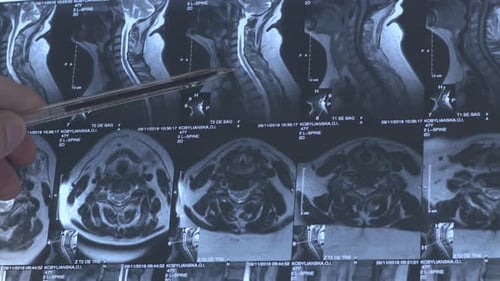 Reviewing MRI Scan with Pen