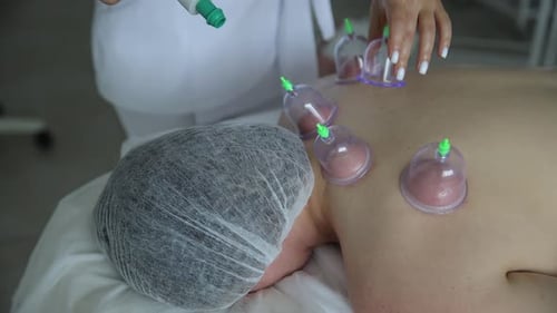 Cupping Therapy Procedure on Patient's Back