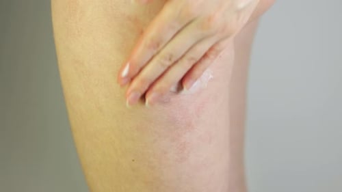 Woman Applying Medicinal Cream to an Irritated Skin Rash on Her Leg
