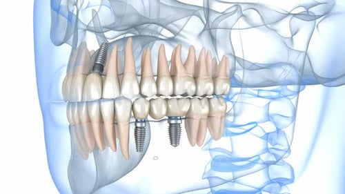 3D Animation of Dental Implants and Human Jaw Anatomy