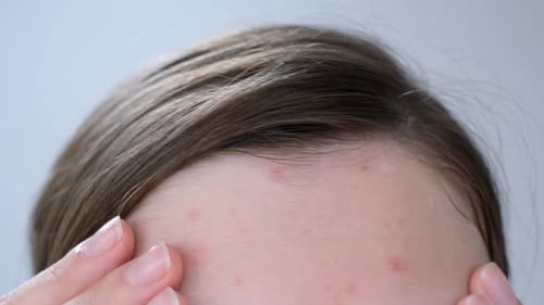 Weibliche Stirn mit roten Pickeln und Entzündungen auf grauem Hintergrund in Nahaufnahme.