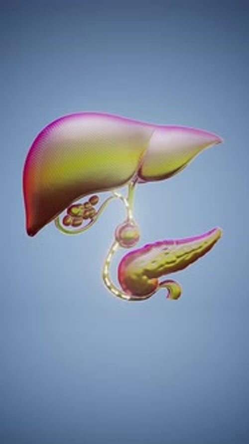 Conceptual 3D animation of a gallbladder stone