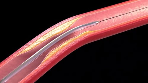 3D Animation of Balloon Angioplasty Medical Procedure in Artery